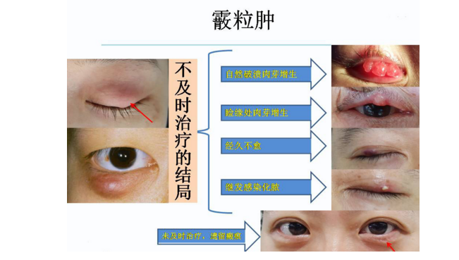 霰粒肿_沧州爱尔眼科